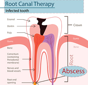 How is an abscessed tooth treated?