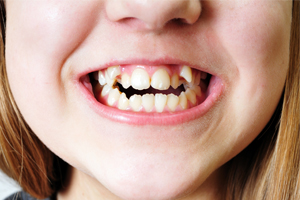 girl smiling, considering getting Vivera® Retainers