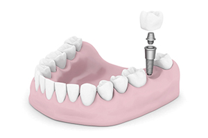 Dental implant