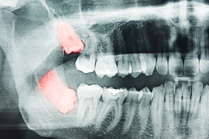 Evaluation for wisdom tooth extraction