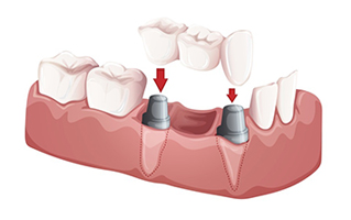 Fixed partial dental bridge