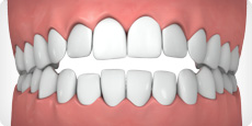 Open bite