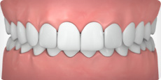 Overbite