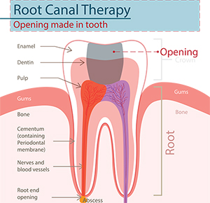 Opening made in tooth